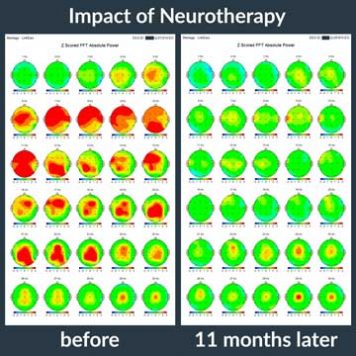 Impact of Neurofeedback Therapy