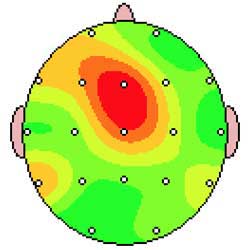 Is Neurofeedback-based Brain training the same as electroshock therapy?” -  ECT